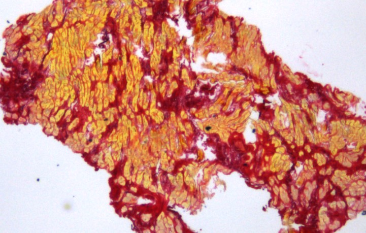 Fibrotischer Herzschnitt