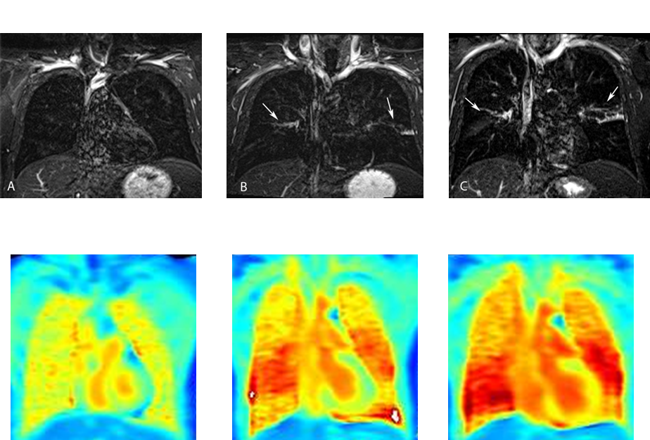 Imaging of local inflammation severity by means of a turbo-inversion recovery magnitude (TIRM) sequence (upper panel) and by oxygen-enhanced T1-mapping (lower panel) in a patient with bronchial asthma prior to (A, left images), 6 hours after (B, middle images) and 24 hours after segmental allergen challenge (C, right images).