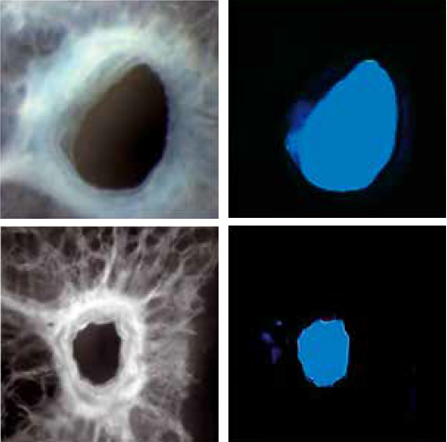 Left image column: microscopic representation of airways opened to different degrees. Right image column: graphical representation of the same airways but as computed models.