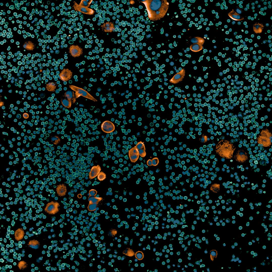 Microscopic image of a pleural effusion from a lung cancer patient